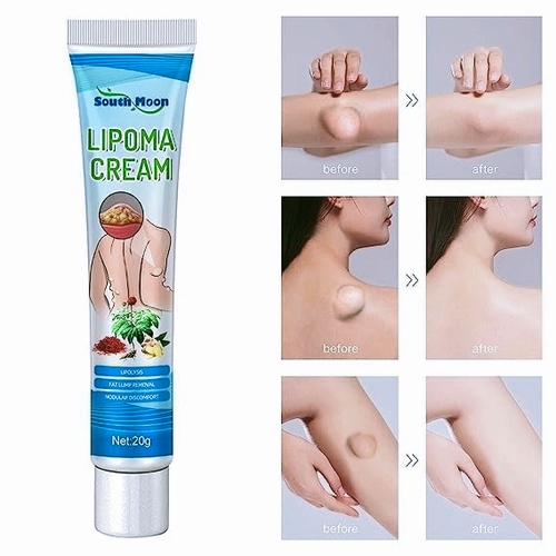 South Moon™ Lipoma Treatment Ointment